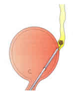 Ureteroscopía